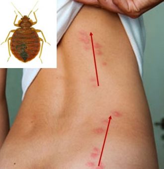 Punture Di Cimici Da Letto Rimedi